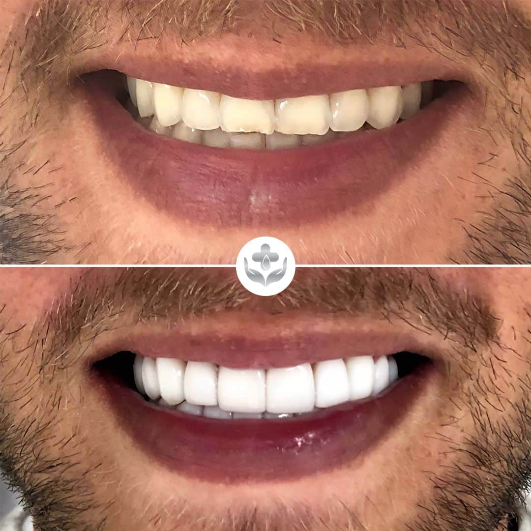 Carillas de resina antes y después, dientes cortos alargados, Medellín, Colombia
