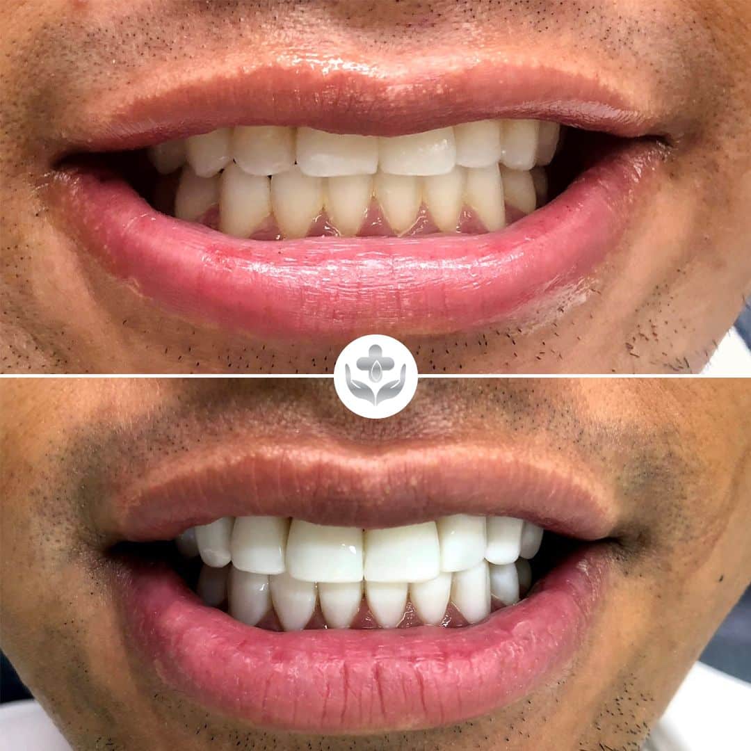 Carillas de resina antes y después, dientes frontales fisurados restaurados, Medellín, Colombia