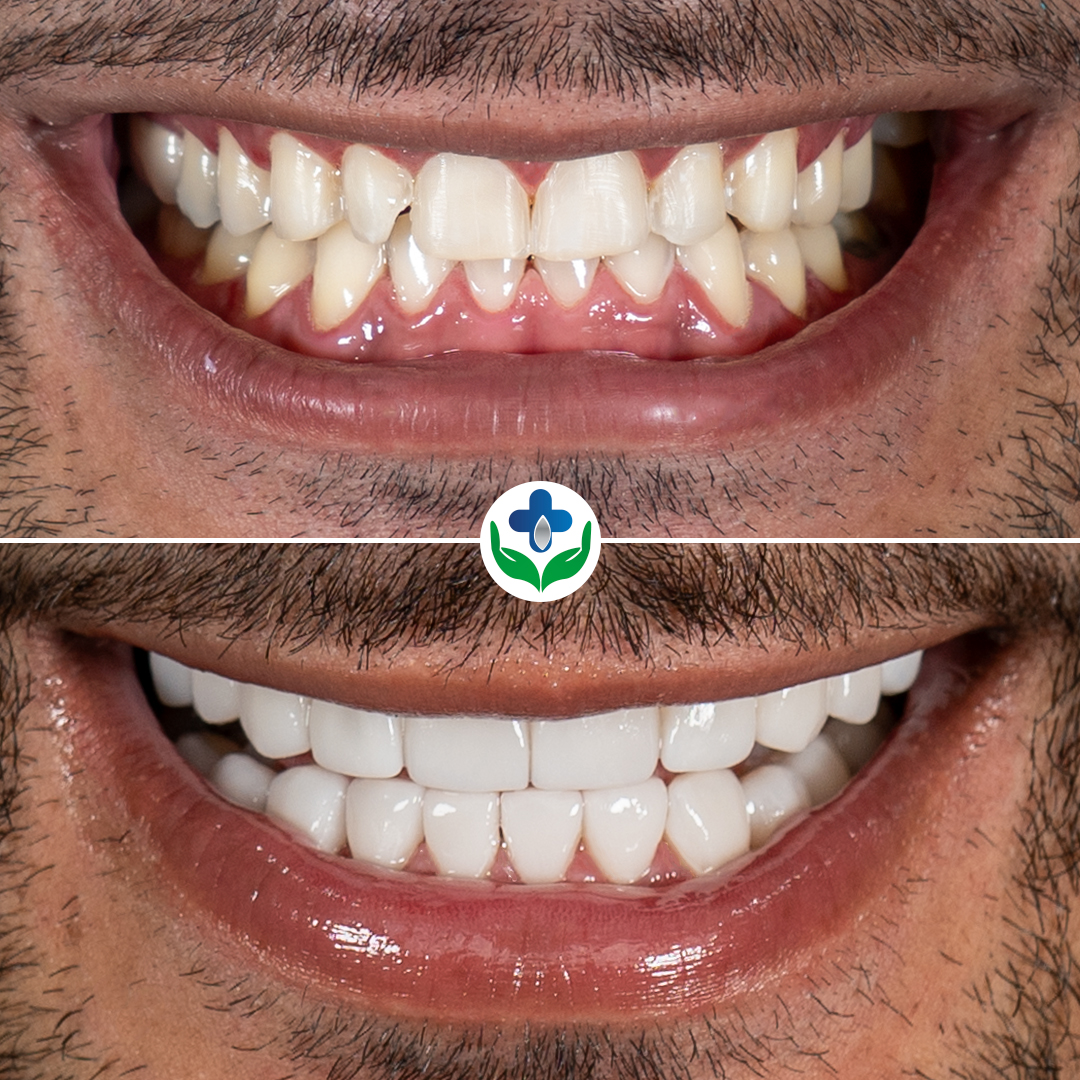 Carillas de resina antes y después, Anthony, Colombia Care Dental, Medellín